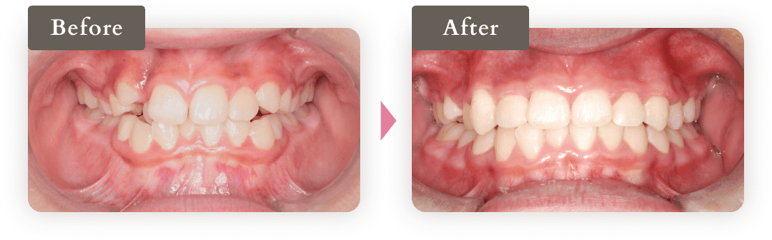 がたついた歯並びの写真（Before）→きれいな歯並びの写真（After）