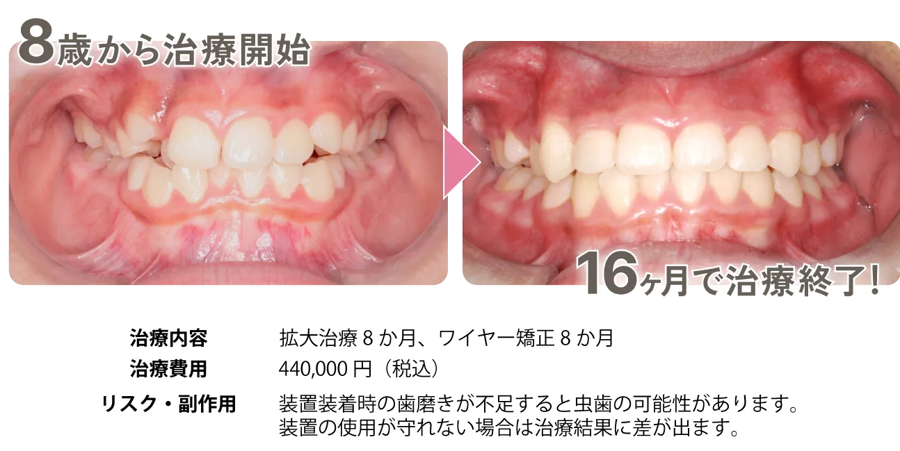 がたついた歯並びの写真（8歳から治療開始）→きれいな歯並びの写真（16ヶ月で治療終了！）