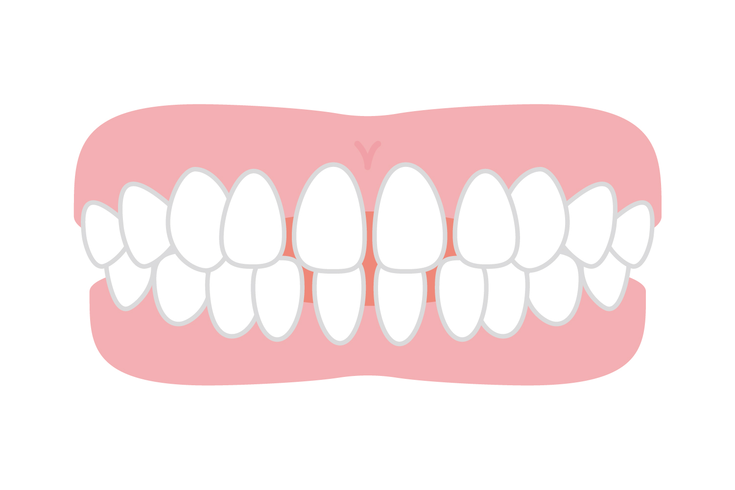 前歯や他の歯と歯の間に隙間が空いているイラスト
