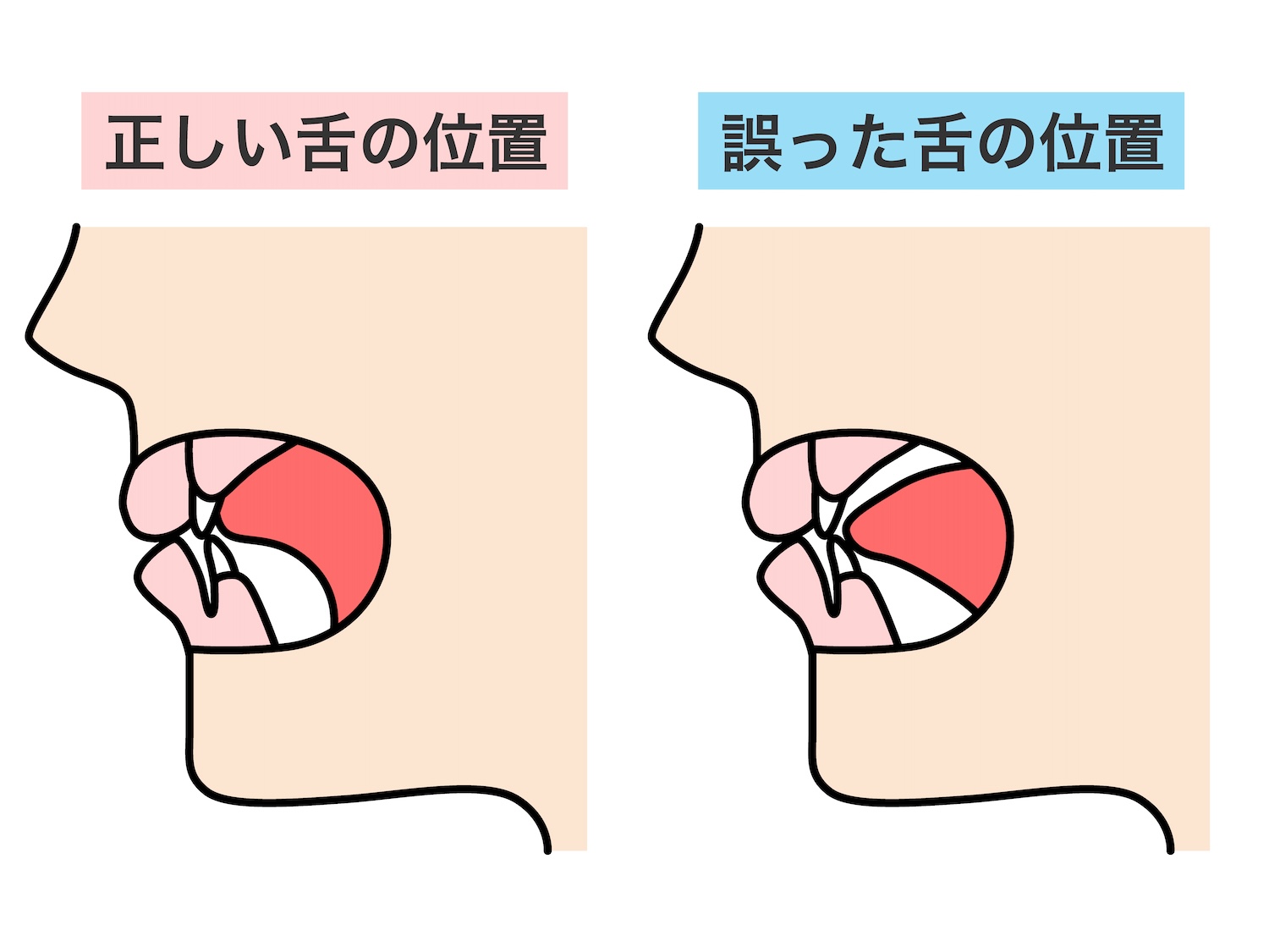 正しい舌の位置（上顎に舌がくっついている）、誤った舌の位置（舌が上顎に触れていない）