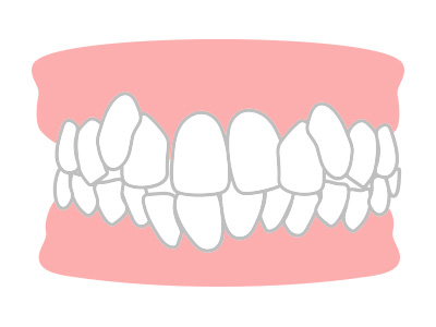 歯並びが悪いイラスト
