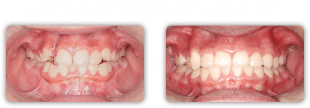 治療前と治療後の比較写真