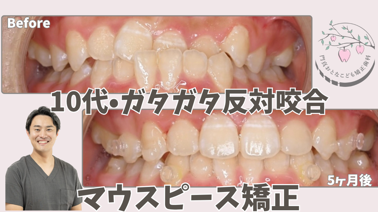【マウスピース矯正・10代】ガタガタと反対咬合が５ヶ月でここまで改善