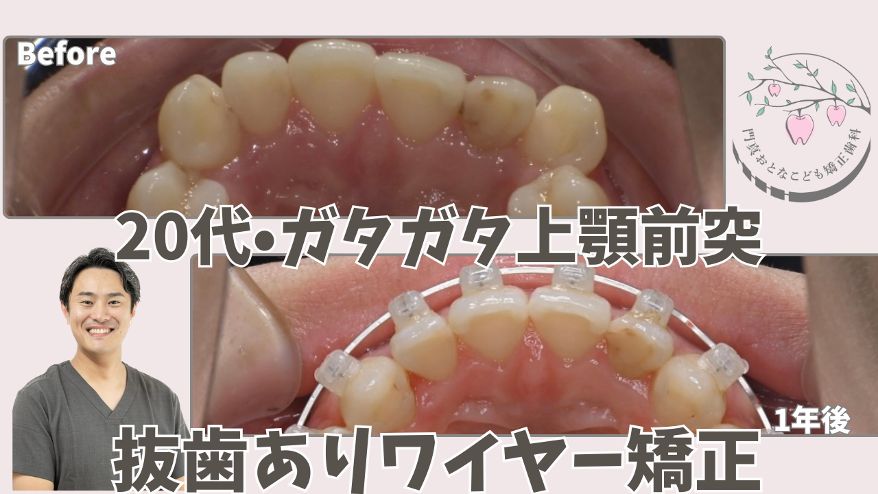 【抜歯ありワイヤー矯正・20代】ガタガタと上顎前突が１年でここまで改善